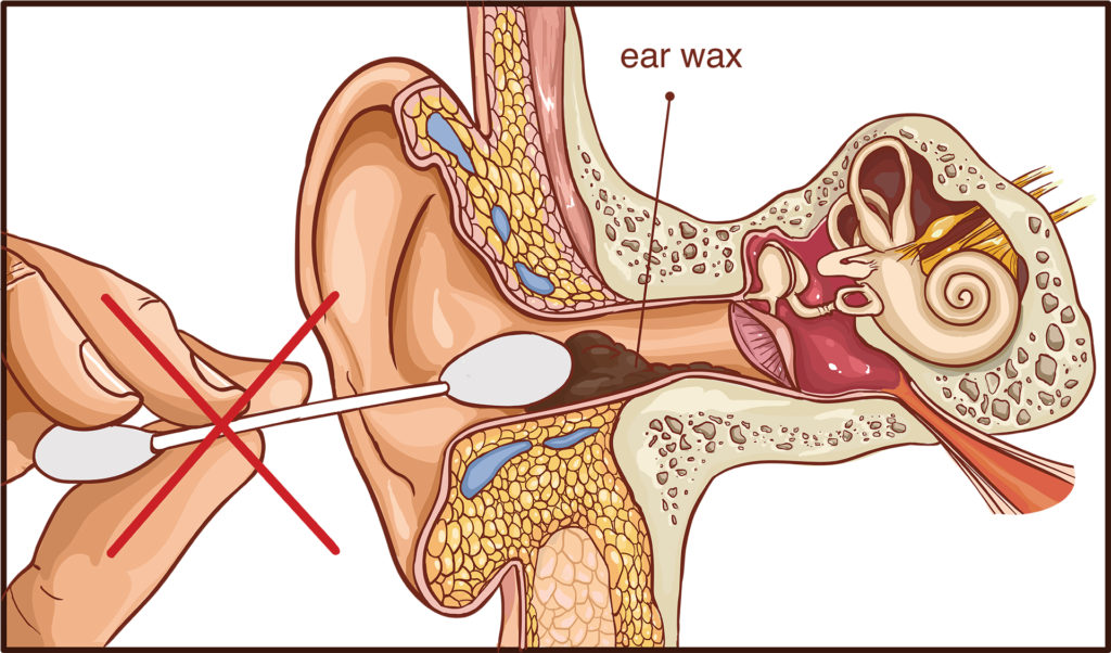 Earwax being pushed into the ear by a cotton bud