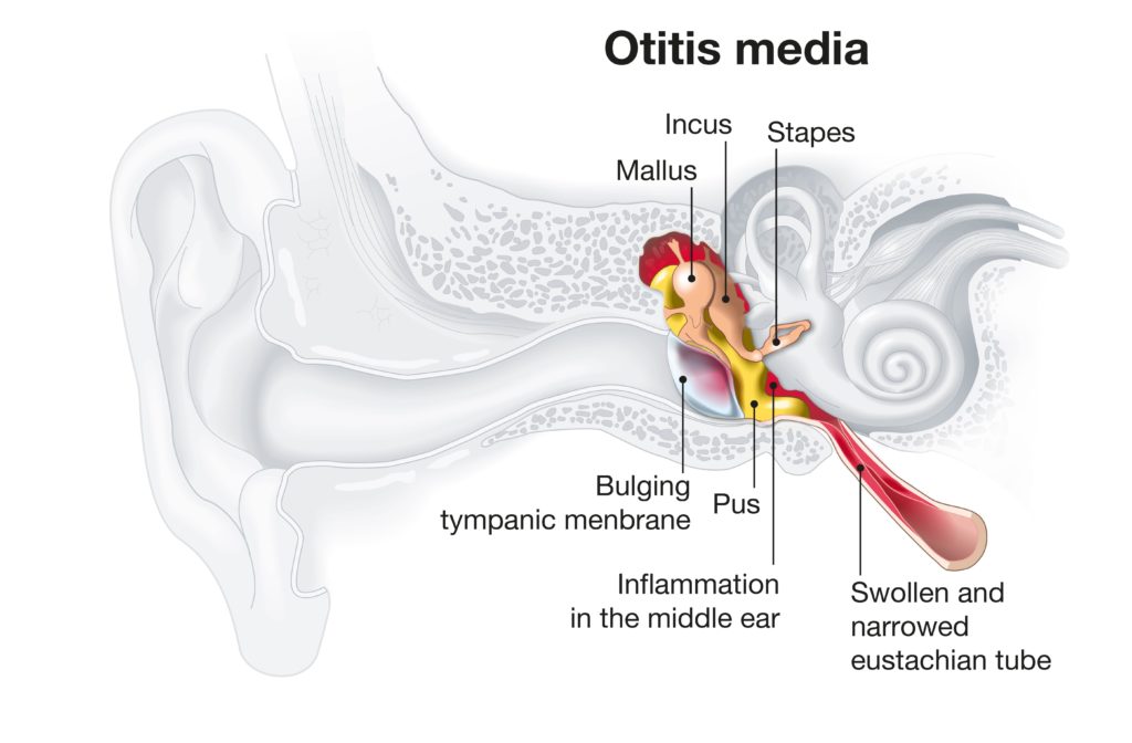 Diagram of ear infection