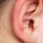 Close up of an ear with earwax build up.
