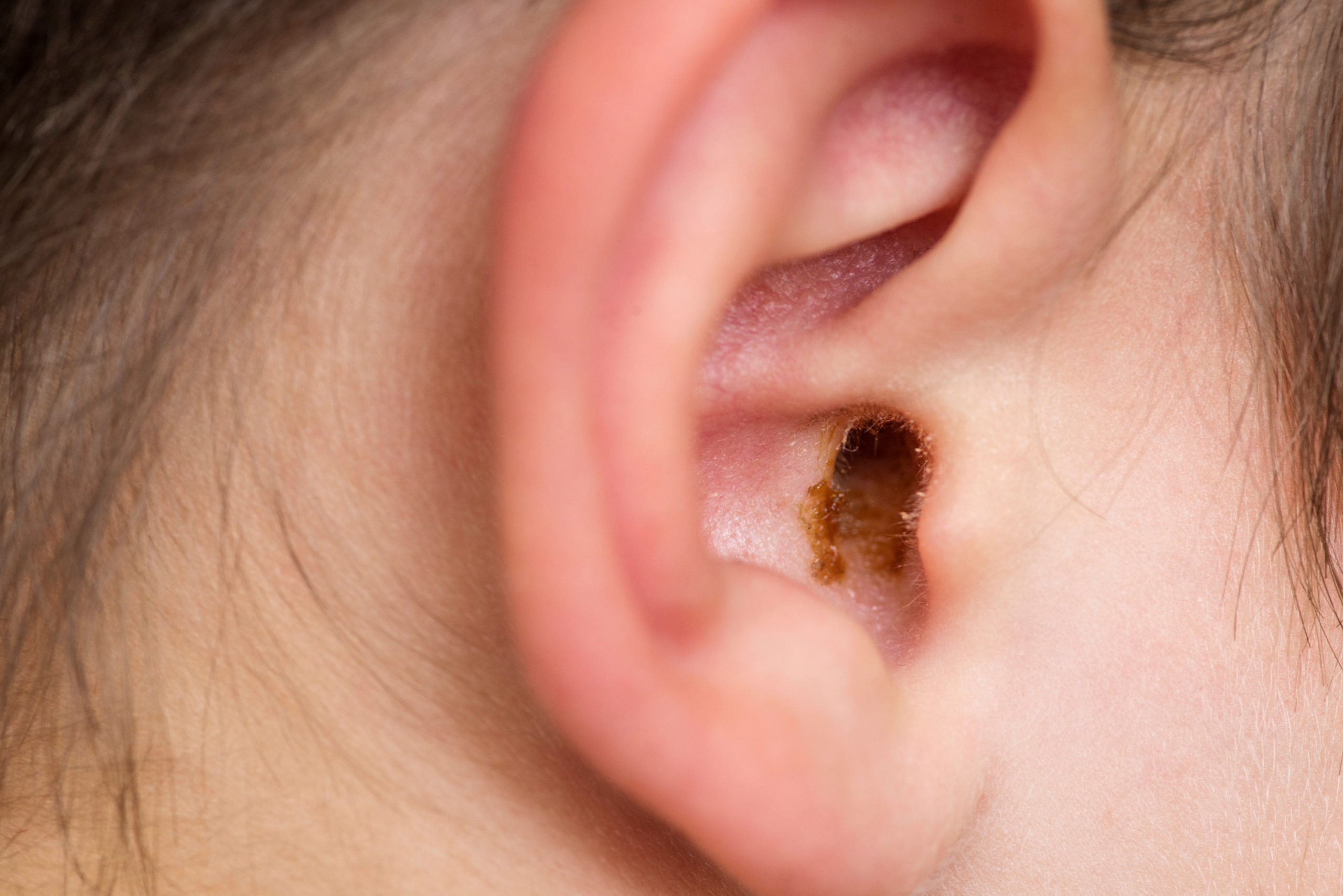 Close up of an ear with earwax build up.